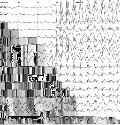 Zapis EEG napadu padaczkowego u dziecka. Jest to tzw. napad nieświadomości (ang. absence seizure) będący napadem uogólnionym.