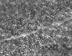 Level of canal dentine clearance canal orifice region) group II (after irrigation with citric acid NaOCl, NaOCl, NaCl. Grupa II.