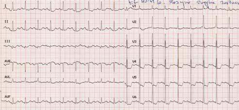 Folia Cardiologica 2014, tom 9, nr 4 Rycina 1. Zapis elektrokardiograficzny zarejestrowany w czasie dolegliwości dławicowych.