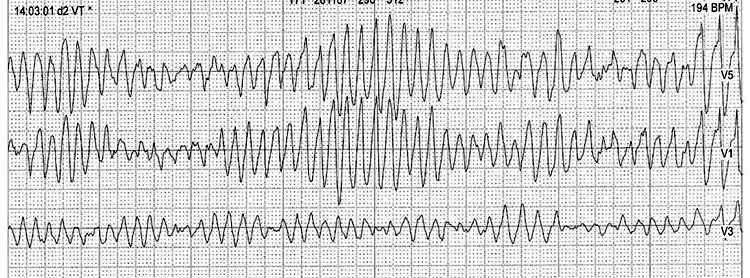 Częstoskurcz z niemiarowymi szerokimi zespołami QRS Torsade