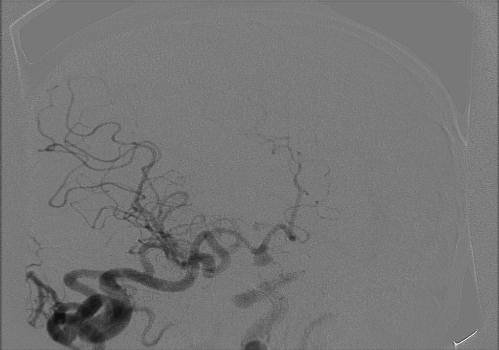 Arteriografia hipoplazja aorty z amputacją na wysokości odejścia tt. nerkowych. Ukrwienie lewej nerki przez krążenie oboczne. Uzyskano częściowe rozszerzenie prawej t. nerkowej.