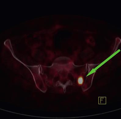 2014 roku obraz choroby nowotworowej był stabilny, porównywalny z badaniem 68 Ga DOTA-TATE PET/CT z 15.05.