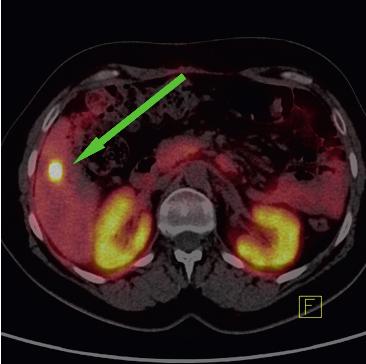 W kolejnych kontrolnych badaniach obrazowych w ciągu 4 lat po zakończonym leczeniu radioizotopowym obserwuje się stabilizację radiologiczną opisywanych zmian w kościach i węzłach chłonnych oraz