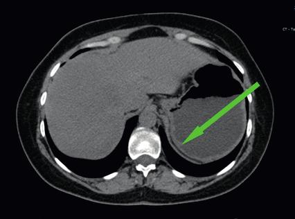 hormonalnie NEN G1/G2 trzustki leczeniem z wyboru są analogi somatostatyny, natomiast w przypadku progresji choroby należy dołączyć do tej terapii inhibitor mtor (ewerolimus).