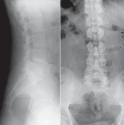Two interspinous spacers in the treatment of bisegmental degenerative disc disease 75 MATERIAL Material consists of 165 patients with degenerative disc disease of lumbar spine operated between 2006
