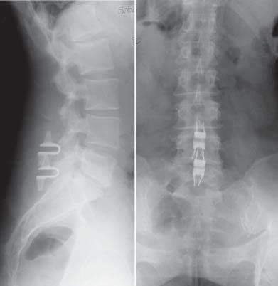 Final evaluation was subjected to 28 (15 women, 13men) patients who had implanted two interspinous devices at two adjacent segment: 20 patients with InsWing implants (FIG.