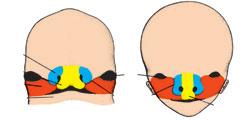 Rowek nosowo- -łzowy Rynienka podnosowa Dzień 45 Przegroda stożka tętniczego i pnia oraz przegroda międzykomorowa Aorta Zastawki płucne Przedsionek