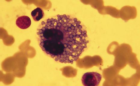 Binuklearny plazmocyt z utratą integracyjności błony komórkowej, złogi immunoglobulin w postaci