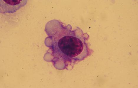 Komórka Mott`a ze złogami immunoglobulin. Rycina 14. Binuklearna forma komórkowa typu plazmoman.