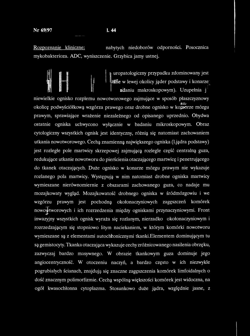 Nr 69/97 1. 44 Rozpoznanie kliniczne: Zespół nabytych niedoborów odporności. Posocznica mykobakterioza. ADC, wyniszczenie. Grzybica jamy ustnej.