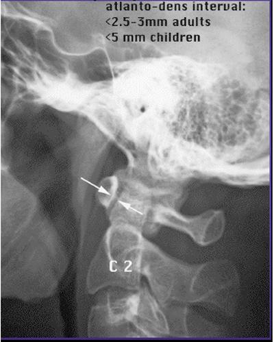 Warianty normy u dzieci Odstęp szczytowo-zębowy ( atlantodental