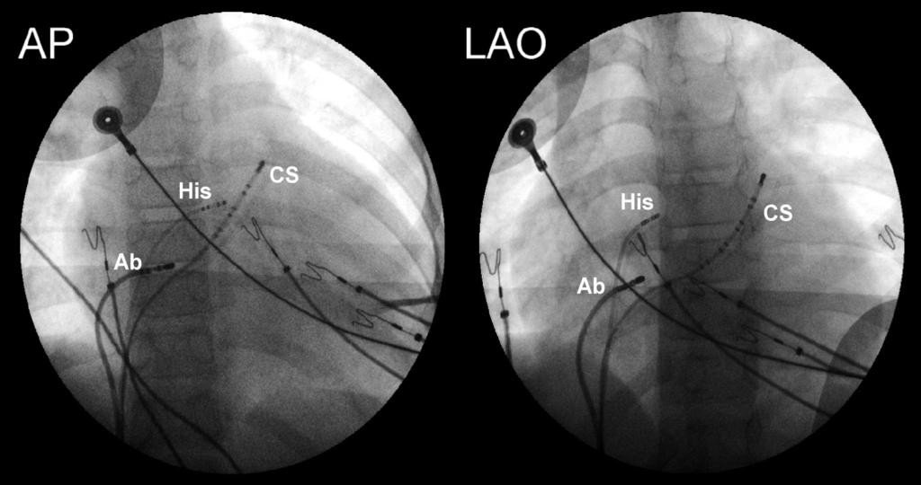 Obraz echokardiograficzny 6 dni przed ablacją (A) ze znaczną rozstrzenią lewej komory oraz uogólnioną i nasiloną hipokinezą ścian lewej komory, a także 7 miesięcy po ablacji (B) z pełną normalizacją