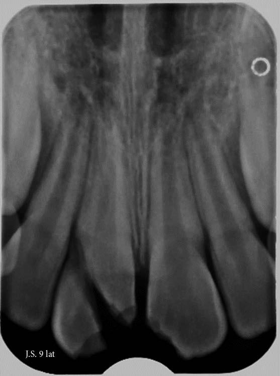 Metody leczenia endodontycznego zębów stałych z niezakończonym rozwojem wierzchołków korzenia apeksyfikacja.