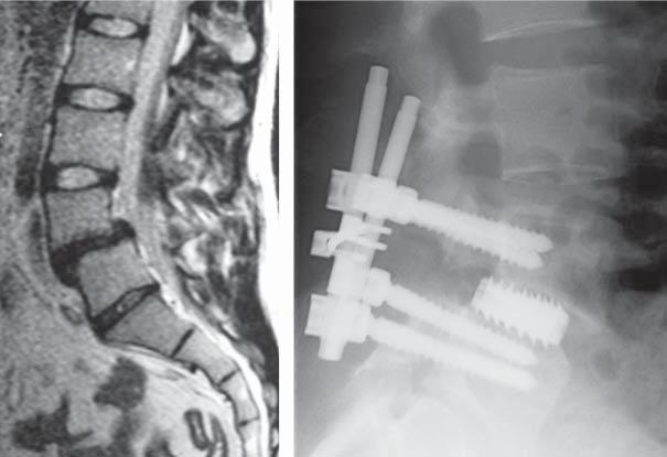 164 A. DOBKIEWICZ, B. BARAN, L. CIUPIK, J. PIENIĄŻEK All patients were qualified into surgical treatment after months of unsuccessful conservative treatment with progression of clinical status.