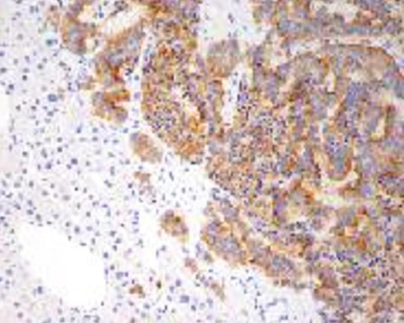 Wyniki badań biochemicznych przed kwalifikacją do leczenia długodziałającym analogiem somatostatyny Markery nowotworowe Wyniki Zakresy referencyjne Chromogranina A 33,87 ng/ml 0 94 beta-hcg 4,7 mjm.