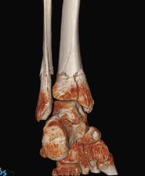 Uwagę zwraca jakość obrazu struktur anatomicznych uzyskana przy użyciu dostępnej wyłącznie w tomografach Philips projekcji Volume Intensity