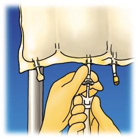 W przypadku wynaczynienia należy natychmiast przerwać podawanie preparatu pozostawiając na miejscu wprowadzony cewnik lub kaniulę w celu natychmiastowego wdrożenia postępowania leczniczego.
