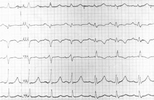 PR interval = = 100 ms. QRS complex = 150 ms. Ryc. 2. Częstoskurcz przedsionkowokomorowy ortodromowy 136/min.