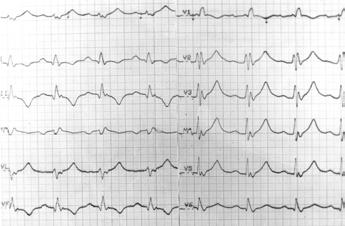 F. Walczak i wsp., Ablacja w zespole Ebsteina Ryc. 4. Po ablacji: zapis EKG w czasie rytmu zatokowego cechy bloku zupełnego prawej odnogi pęczka Hisa. Odstęp PR = 200 ms. Zespół QRS = 165 ms. Fig. 4. After RF-ablation EKG recording during sinus rhythm a manifest right bundle branch block.