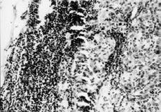 Złośliwość guzów chromochłonnych Kajor M. Ryc. 1. Przerzut złośliwego guza chromochłonnego do węzła chłonnego okołoaortalnego (jednoznaczne potwierdzenie złośliwego charakteru guza; H&E x 140). Fig.
