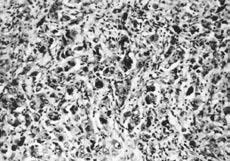 Fig. 3. Atypical mitotic figures within malignant pheochromocytoma (2 points in PASS; H&E x 140). a największą wielkością guza w badaniach obrazowych jak również wiekiem chorych w chwili zabiegu.