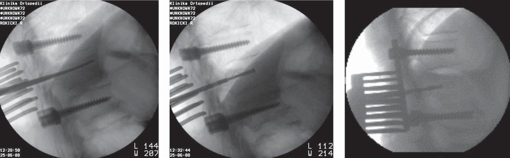 82 R. NOWAK, A. BARCZYŃSKI, W. MIECZNIKOWSKI, J. SZPUNAR probe was performed in 11 patients.