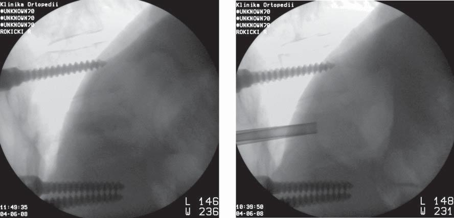 Transpedicular short-segment stabilization of thoracic and lumbar spine fractures with transepiphyseal reposition 83 calculated in percents in proportion to average height of vertebral bodies of