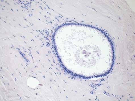 Nowe i kontrowersyjne jednostki morfologiczne w patologii gruczołu piersiowego Rycina 1.