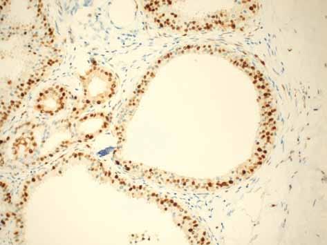 Atypowe jądra komórkowe w tych zmianach mają okrągłe lub owalne kształty i gładkie kontury, chromatyna jest drobnoziarnista, a jąderka niewidoczne. Cytoplazma jest amfofilna i ziarnista.
