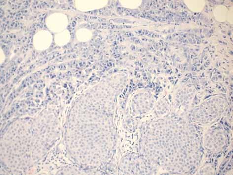 Nowe i kontrowersyjne jednostki morfologiczne w patologii gruczołu piersiowego Rycina 9. Pleomorficzny rak zrazikowy in situ Rycina 10.