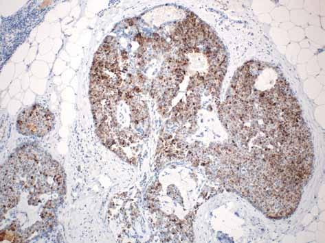 Nowe i kontrowersyjne jednostki morfologiczne w patologii gruczołu piersiowego Rycina 24. Rak brodawkowaty lity in situ, materiał operacyjny, chromogranina Rycina 25.