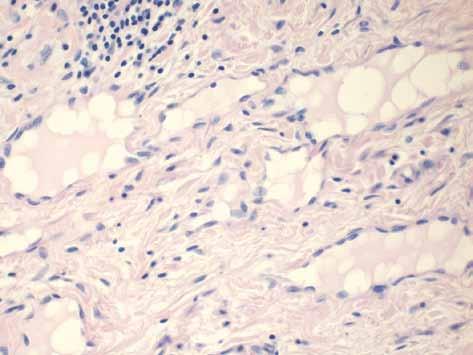 W kręgu różnicowym raka brodawkowego litego znajdują się następujące zmiany nowotworowe: rak brodawkowaty otorebkowany, nowotworzenie wewnątrzzrazikowe, rak wewnątrzprzewodowy wariant lity, adenoid