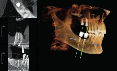 Endodoncja: ocena korzeni w trzech wymiarach Ortognatyka: diagnostyka stawów skroniowo-żuchwowych Analiza dróg oddechowych: wizualizacja zwężonych dróg oddechowych Oprogramowanie dostarczane z