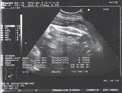 Figure 1. Fetal distal femoral epiphysis size measurement from the outer-to-outer margins in an axial plane of epiphyses.