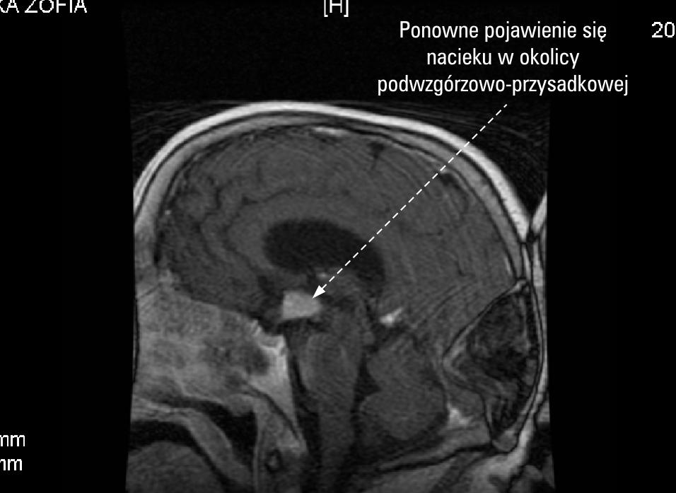 niejednorodna 18 mm, izoechogenne Tabela III Wyniki oznaczeń hormonalnych po miesięcznej terapii tyreostatykiem Table III Hormone results after one-month therapy with thyrostatics Hormon Wynik Norma