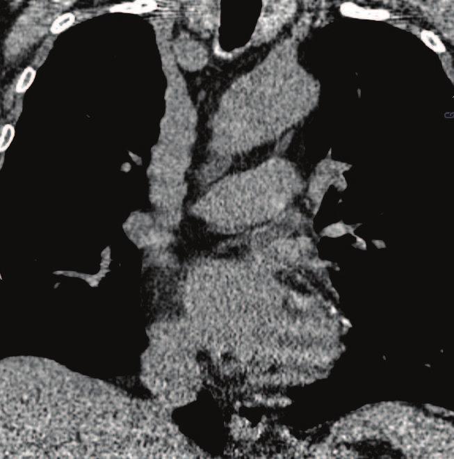 28 Sylwia Pisiak Ryc. 2. Niskodawkowa tomografia komputerowa klatki piersiowej projekcja czołowa. Widoczne odcinkowe zwapnienia w gałęzi przedniej zstępującej lewej tętnicy wieńcowej Fig. 2. Low-dose CT-scan of the chest, frontal projection.