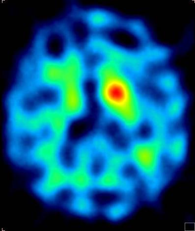 BADANIE DaTSCAN W CHOROBIE PARKINSONA SPECT z użyciem znacznika o nazwie handlowej DaTSCAN (123I-phenyltropane) uwidacznia gęstość