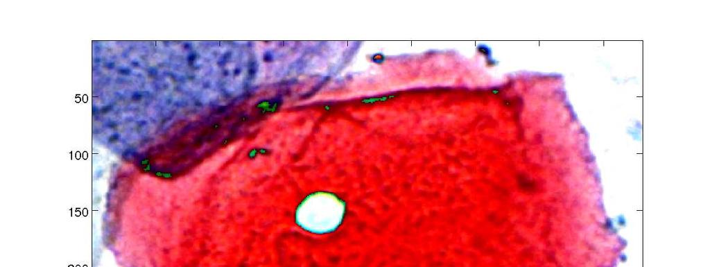 Human Papilloma Virus), czyli m.in. zagęszczenie cytoplazmy na obwodzie komórki i przejaśnienie, tzw. halo wokół jądra z hiperchromazją. Rys. 7.