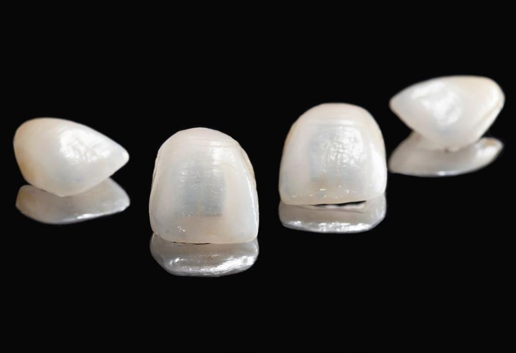 LICÓWKI PEŁNOCERAMICZNE (VENEERS) Licówki pełnoceramiczne stosuje się, aby skorygować kształt, kolor lub wielkość zębów. Zalecane są w przypadkach intensywnych przebarwień koron zębów (np.