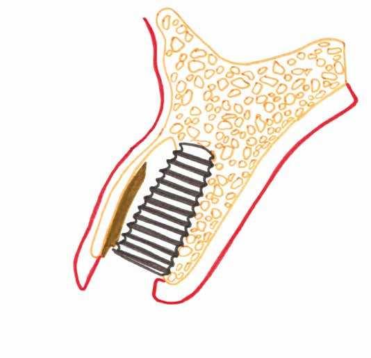 Blaszka kostna przedsionkowa (buccal bone), zwykle ulegająca resorpcji poekstrakcyjnej Pozostawiony fragment; ozębna-cement-zębina środek implantów i próbki poddano ocenie histologicznej.