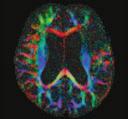 Polski Przegląd Neurologiczny, 2010, tom 6, nr 1 Rycina 15. Ognisko zawałowe w obszarze unaczynienia lewej tętnicy środkowej w obrazie T2-zależnym ().