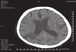 Polski Przegląd Neurologiczny, 2010, tom 6, nr 1 Obowiązujące do dziś standardy diagnostyki udaru mózgu w jego poszczególnych fazach opierają się na dwóch głównych metodach radiologicznych: