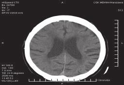 Jerzy Walecki, Diagnostyka obrazowa wczesnego udaru mózgu wyższonej gęstości z powodu zwapnień miażdżycowych w ścianach tętnic (zmiany utrwalone, powtarzające się w badaniach kontrolnych) oraz w
