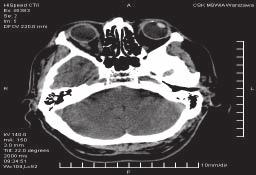 Polski Przegląd Neurologiczny, 2010, tom 6, nr 1 Rycina 5. Chory w wieku 68 lat, u którego nagle wystąpiły zburzenia równowagi i silny ból głowy:.