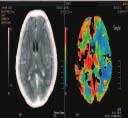 Jerzy Walecki, Diagnostyka obrazowa wczesnego udaru mózgu C Rycina 8. Perfuzja TK u 75-letniej chorej z przemijającym niedowładem prawostronnym i afazją (TI, transient ischaemic attack).