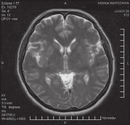 Jerzy Walecki, Diagnostyka obrazowa wczesnego udaru mózgu C D E Rycina 9. Chora w wieku 58 lat badana w okresie nadostrym (2 h od wystąpienia objawów lewostronnego niedowładu i niedoczulicy).
