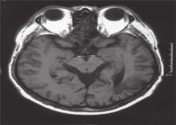 Polski Przegląd Neurologiczny, 2010, tom 6, nr 1 C Rycina 10.