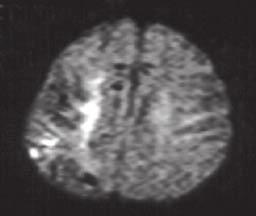Wzrost współczynnika dyfuzji (DC, apparent diffusion coefficient) oraz obniżenie sygnału w obrazowaniu dyfuzyjnym (DWI,