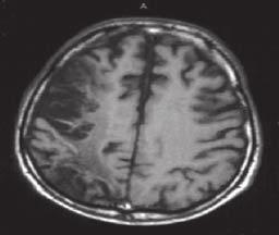 hemodynamiczny, a angiografia MR (MR, magnetic resonance angiography) stan naczyń mózgowych oraz wykrycie ewentualnych zwężeń i