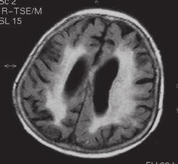 Jerzy Walecki, Diagnostyka obrazowa wczesnego udaru mózgu C D Rycina 12. Pacjentka 81-letnia z afazją oraz niedowładem połowicznym prawostronnym od około 28 godzin.